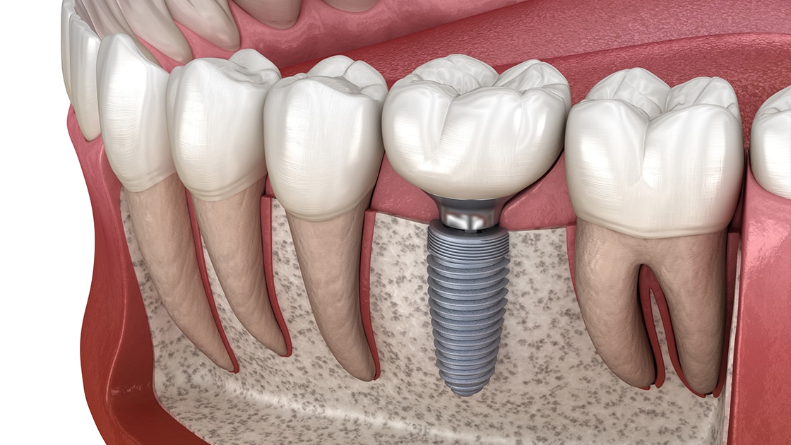 Dental implant education, illustrative dental-care visual