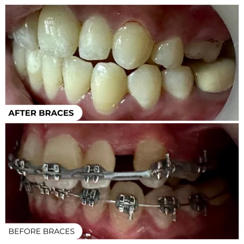 Real patient: teeth before and after braces