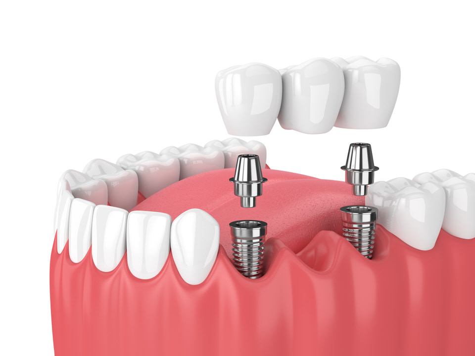 Implant-supported bridge, illustrative dental-care visual