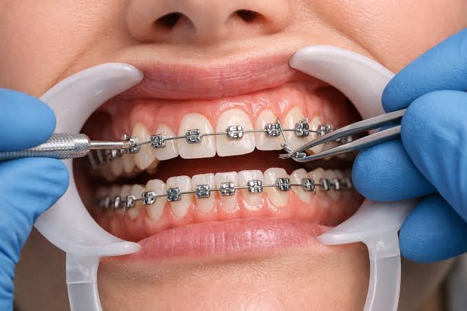 Orthodontic braces, illustrative dental-care visual